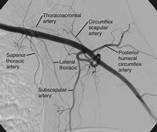 Image result for What Is an Angiogram On Shoulder