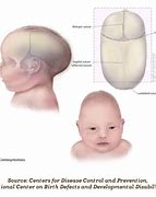 Image result for Baby with Weird Head Shape