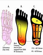 Image result for Plantar Wart Symptoms