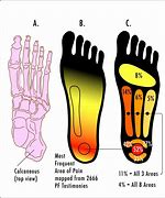 Image result for Plantar Warts On Feet Diagram