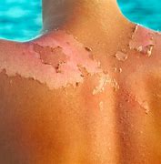 Image result for SunBurn Peel