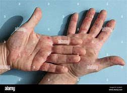 Image result for Allergy Blisters