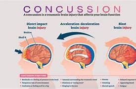 Image result for Concussion Memory Loss