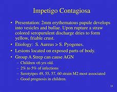 Image result for Impetigo Contagiosum