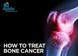 Image result for Collar Bone Cancer Symptoms