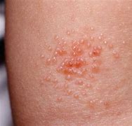 Image result for Infectious Molluscum