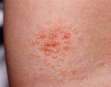 Image result for Molluscum Viral Skin Infection