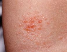 Image result for Molluscum Contagiosum Skin Infection On Cheek