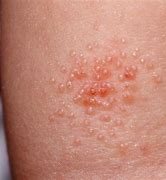 Image result for Molluscum Contagiosum Skin Rash