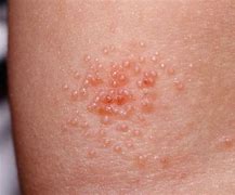 Image result for Molluscum Skin Lesion