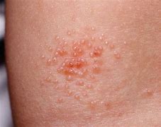 Image result for Molloscum Cantagiosum Back of Knees