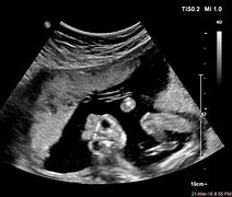 Image result for Fetal Anencephaly