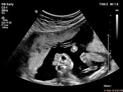 Image result for Anencephaly On Ultrasound