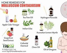 Image result for Natural Remedy for Molluscum