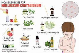 Image result for How to Cure Molluscum Contagiosum