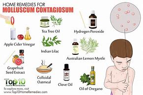 Image result for How to Get Rid of Molluscum Naturally