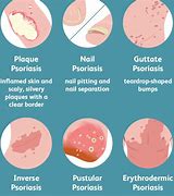 Image result for Psoriasis