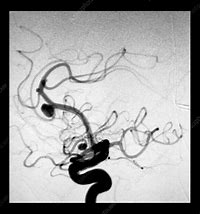 Image result for Cerebral Aneurysm Angiogram