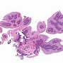 Image result for Esophageal Papilloma