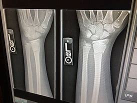 Image result for Broke My Arm