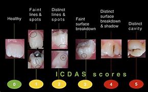 Image result for Dermatoglyphics in Dental Caries