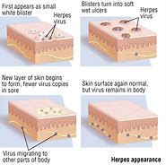 Image result for HPV Genital Warts Man