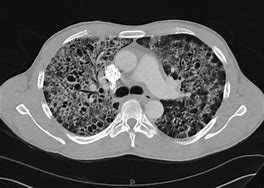 Image result for Pneumocystis Carinii Pneumonia