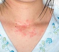 Image result for Allergy Itching