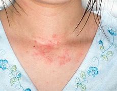 Image result for Red Allergy Skin