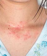 Image result for Skin Reaction Allergies
