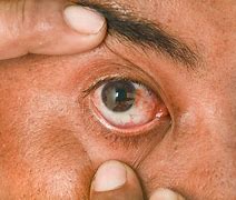 Image result for Brown Spot On Eye White