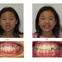 Image result for UnderBite Braces Before and After