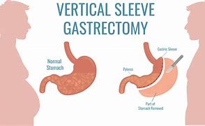 Image result for Sleeve vs Bypass