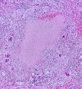 Image result for Lung Biopsy Tuberculosis
