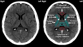 Image result for CT Scan of OCD Brain