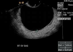 Image result for Ovarian Cyst Surgery Scar