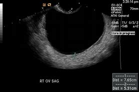 Image result for Different Types Ovarian Cyst