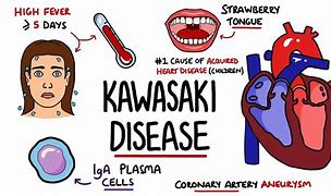 Image result for Crash Kawasaki Disease