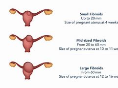 Image result for Uterine Fibroid Uterus Size Chart