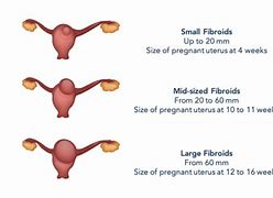 Image result for 7 Cm Fibroid
