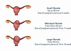 Image result for 5 Cm Fibroid Size