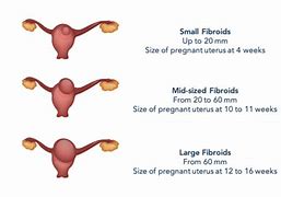 Image result for 2 Cm Fibroid in Uterus