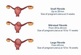 Image result for 5 Cm Uterine Fibroid