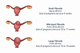 Image result for 10 Cm Fibroid