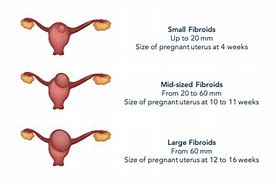 Image result for 3 Cm Fibroid in Uterus