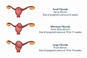 Image result for 2 Cm Fibroid