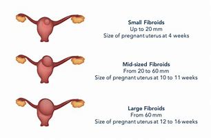 Image result for 8 Cm Fibroid Size