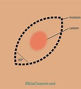 Image result for Alexa Bliss Skin Cancer Procedure