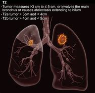 Image result for Stage 2 Lung Cancer