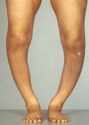 Image result for Rickets Disease Brochure